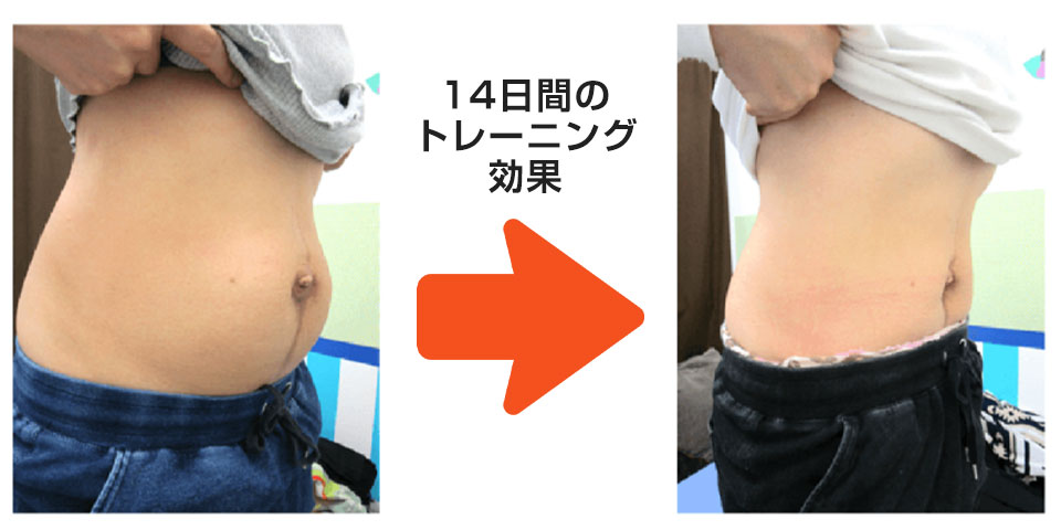 腹直筋離開の実例・喜びの声